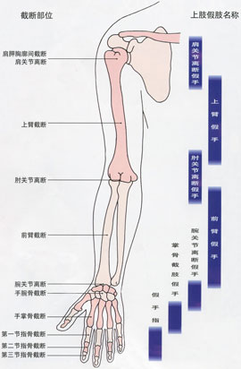 上肢假肢的结构解析 | 佳满假肢