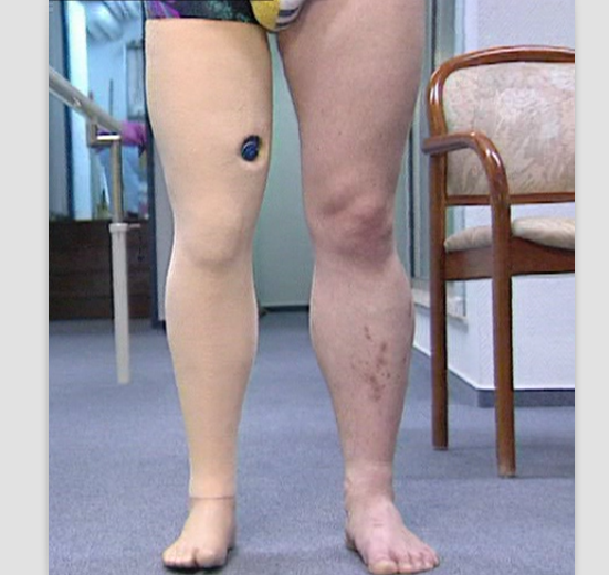 奥托博克大腿假肢接收腔取型制作视频