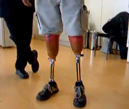 碳纤维双管小腿假肢视频